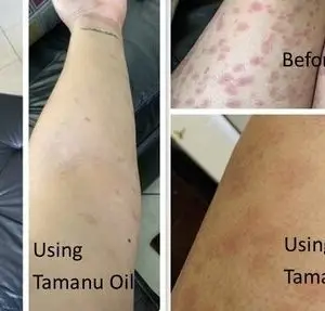 Psoriasis Treatments